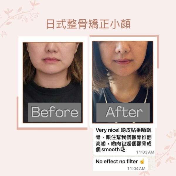 日式整骨矯正小顏 (按金$500)：圖片 2